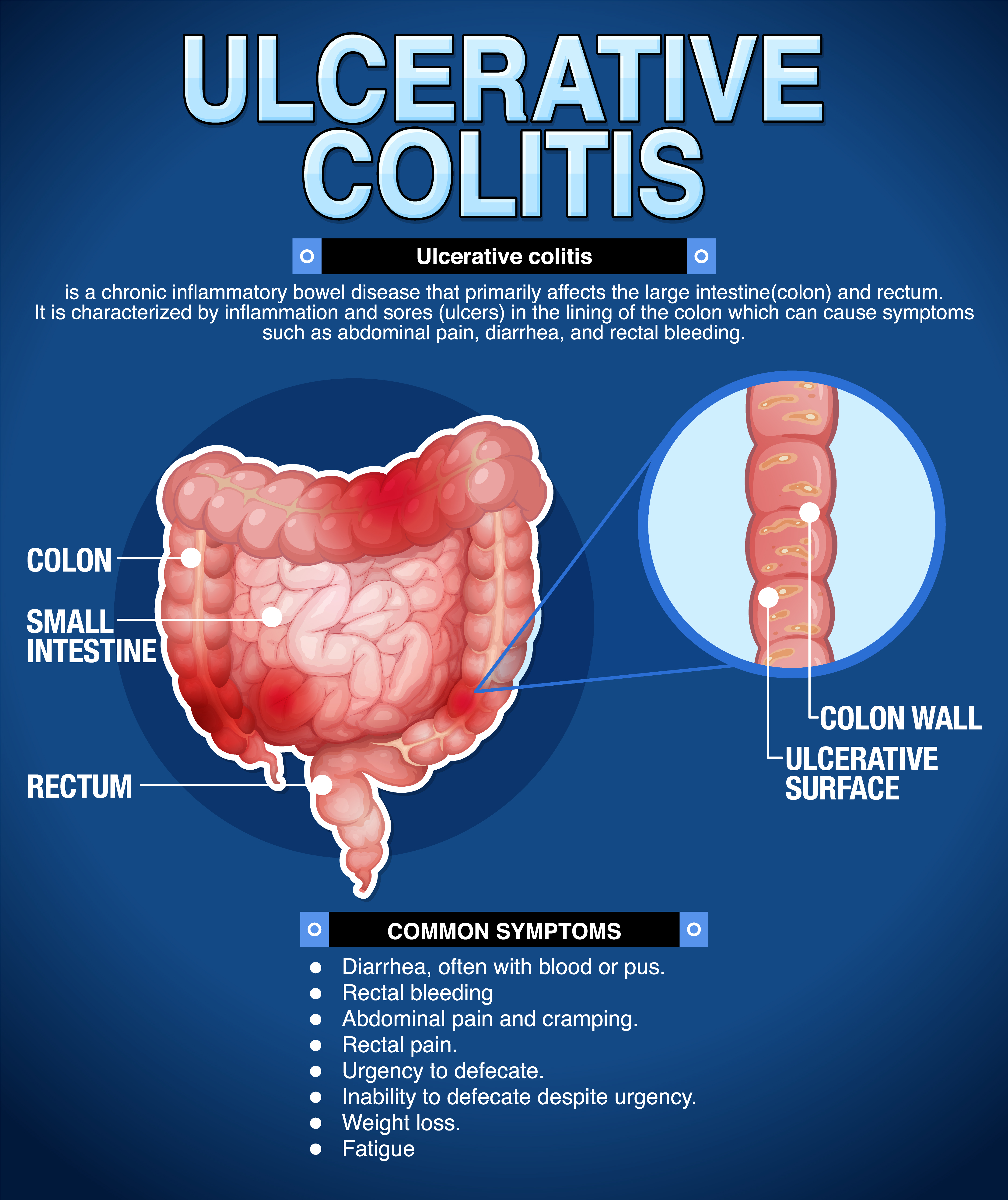 Colorectal Cancer/Colonoscopy